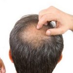 Leczenie łysienia wypadanie włosów
